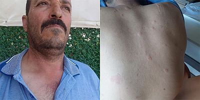 AYININ ELİNDEN KURTULDU ARI SOKMASI SONUCU HASTANELİK OLDU
